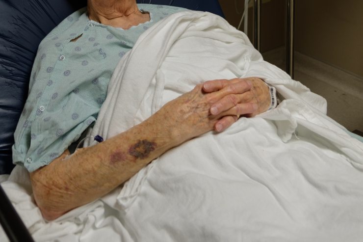 Donna anziana su un letto d'ospedale