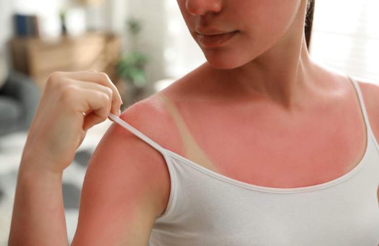 ragazza con pelle scottata dal sole